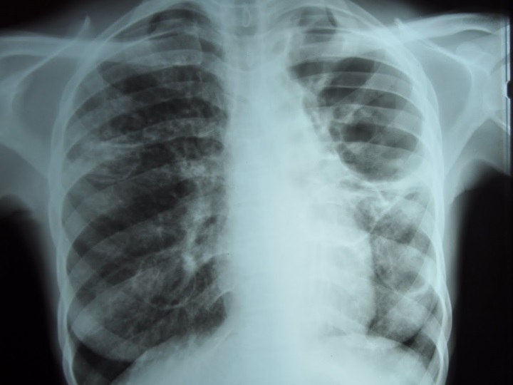 Dijagnoza tuberkuloze